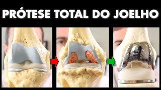 Quanto custa uma cirurgia de prótese de joelho [upl. by Desma]