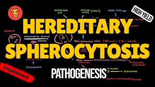 HEREDITARY SPHEROCYTOSIS Pathogenesis Clinical Symptoms Treatment [upl. by Cirdla]