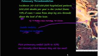 58PEtiology of Pulmonary embolism Saddle embolus Paradoxial embolism [upl. by Pyne]