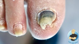 WHY IS HER BIG TOENAIL SO THICK amp DARK HOW TO TREAT DAMAGED TOENAILS [upl. by Ahsilif]