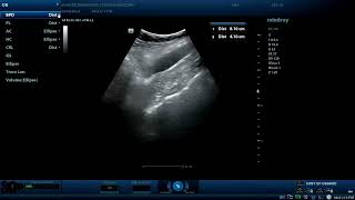 Hydrosalpinx Diagnostic ultrasound cases [upl. by Elliot]