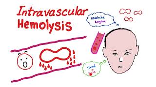 Intravascular Hemolysis [upl. by Reeve]