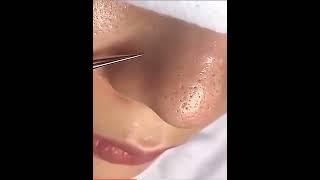 blackhead remover [upl. by Sherourd]