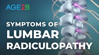 What Are the Symptoms of Lumbar Radiculopathy  Spinal Nerve Root Pain  Disc Bulge [upl. by Jalbert]