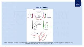 Early Repolarization Syndrome [upl. by Rojas]