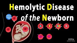 Hemolytic Disease of the Newborn HDN Animation [upl. by Irrabaj23]