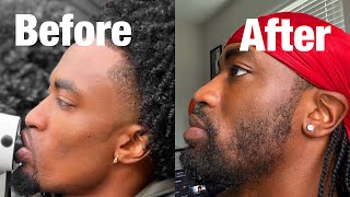 How to Grow a BEARD with a Dermaroller [upl. by Crowns]