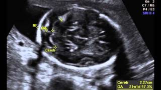 Fetal Anatomic Survey [upl. by Dessma]