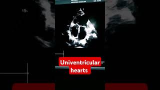 Single Ventricleuniventricular hearts congenital heart defect CHDuniventricular hearts [upl. by Yednarb]