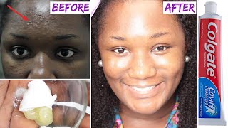 😱 I Applied toothpaste and vaseline on my face and See what happened the next day [upl. by Atteram]