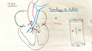 Tetralogy Of Fallot  TOF concised handwritten notes [upl. by Lamiv]