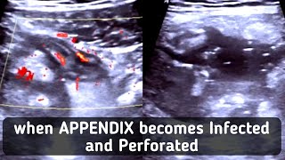 Ultrasound Complicated Perforated Appendicitis [upl. by Eartha]