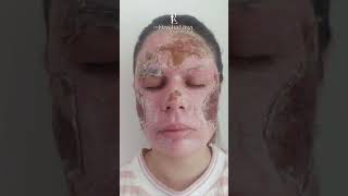 Peeling de Fenol para cicatrizes de acne [upl. by Ttesil441]