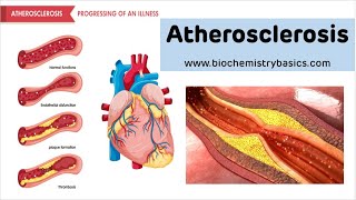 Atherosclerosis  Risk factors Pathophysiology and Prevention [upl. by Ellwood]