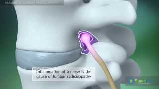 Lumbar Radiculopathy Reasons [upl. by Aitnauq]