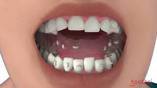 Toothsi Aligner Teeth Alignment Teeth Straightening  Teeth Gap Treatment [upl. by Nelluc]