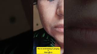 How to avoid itching purging nd side effects of Tretinoin cream before ampafter Tretinoin RetinoA [upl. by Eryn]