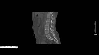 bilateral pars defect on CT scan [upl. by Ansela558]