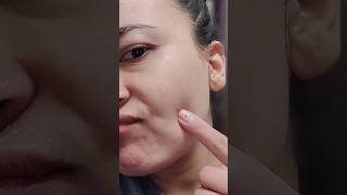 pimple patches reviews nykaa shorts pimpleproblem punjabisong youtubeshorts [upl. by Esadnac]