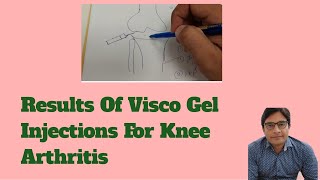 Benefits Of Visco Gel Injections For Knee Arthritis [upl. by Enasus]