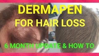 Micro Needling for Hair Loss  How I Use My Derma Pen [upl. by Ahsiekram646]