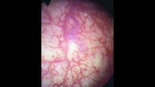 Cystoscopy of Interstitial Cystitis [upl. by Ajram279]