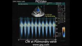 echocardiogram of severe pulmonary stenosis [upl. by Diarmit]