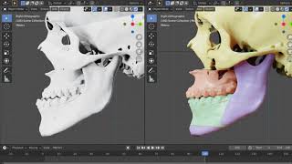 Virtual planning for orthognathic surgery [upl. by Femmine]