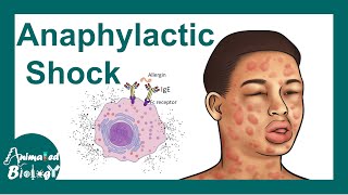 Anaphylactic shock  Anaphylactic Reaction Symptoms and Treatment [upl. by Neeli]