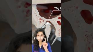 How TMJ DISORDER OCCURS  tmj tmjdisorder tmjpain shorts viralvideo dentalcare trending [upl. by Etty851]