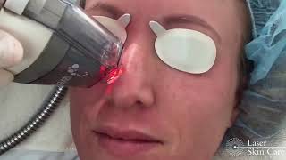 Fraxel Restore Laser Treatment [upl. by Ahc]