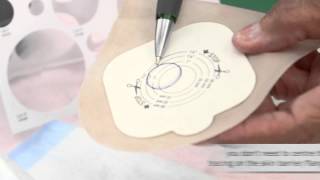 Changing a onepiece ostomy bag for parents [upl. by Adnirem]