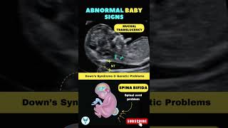 Abnormal Baby signs 👨‍⚕️🧬 Downs Syndrome amp Genetic Problems shortsfeed baby genetics pregnancy [upl. by Azil]