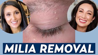 How Do You Remove Milia A Dermatologist Shares Milia Treatment amp Prevention Tips  DERM CHAT [upl. by Eugenia610]