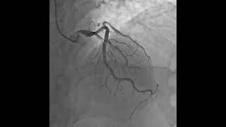 Coronary angiography video 23 [upl. by Ayahs]