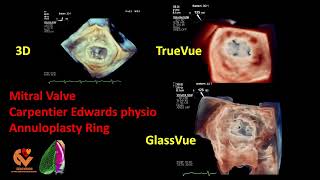 Mitral Valve Carpentier Edwards Physio Annuloplasty Ring [upl. by Dnalyk]