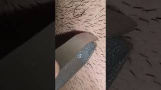 ingrown hair removal [upl. by Nalrah]