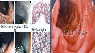 lip hemangioma viralvideo shortsyoutube shortsyoutube viralvideo reelsfb [upl. by Azpurua305]