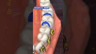 Elastic BAND BRACES ORTHODONTICS [upl. by Caines]