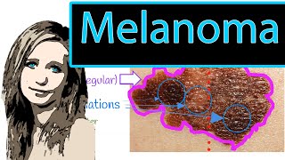 Malignant Melanoma  How To detect Melanoma early ABCDE rule Types of Melanoma [upl. by Durgy305]