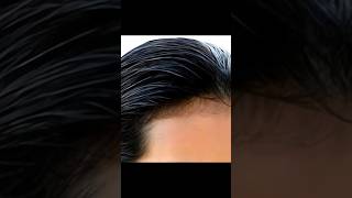 Hair Transplant Me Kitna Paisa Lagta Hai [upl. by Angelico865]