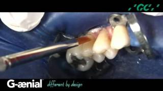 Gænial Class V Restoration  Restoring the Maxillary Right Premolars Video [upl. by Hafeetal560]