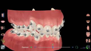 Traitement orthodontie avec bagues Dr Eric Ursat Strasbourg [upl. by Gader]