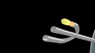 3D Animated Video Explaining 3way Foley catheter with an inflow port [upl. by Shamus566]