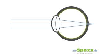 Was ist Weitsichtigkeit Hyperopie [upl. by Ferneau]