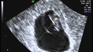 7 weeks 3 days ultrasound [upl. by Papert]