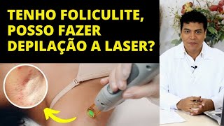 QUEM TEM FOLICULITE PODE FAZER DEPILAÇÃO A LASER SAIBA [upl. by Craw115]