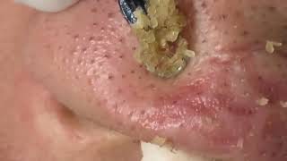 Acne 58  Blackheads on the nose like lovely pearls [upl. by Ynttirb210]