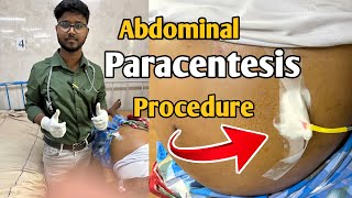 How I do abdominal paracentesis easily during internship after passing FMGE  Abdominal Tap [upl. by Yralam]