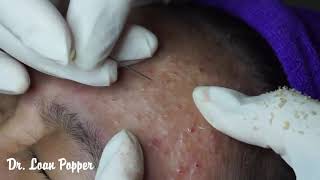 Acne Blackheads Whiteheads removals on face part 16  How to get rid of blackheads easy [upl. by Jenkins451]